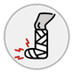 fracture leg